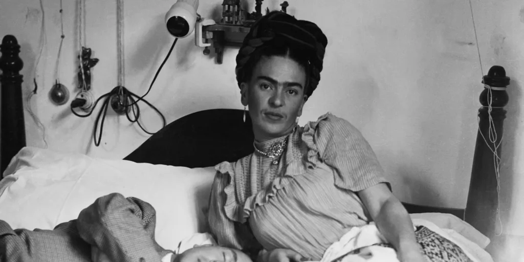 Frida Kahlo síndrome 